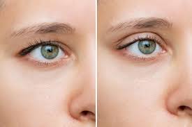 Common Cosmetic Eye Surgeries People Seek for Defined and Attractive Features