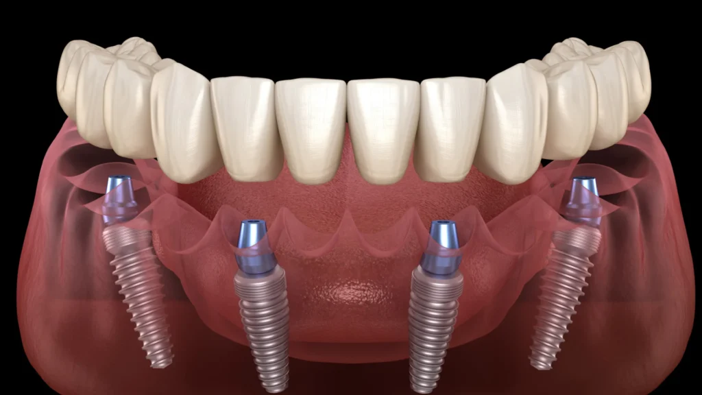 Long-Term Benefits of All-on-4 Full Mouth Implants
